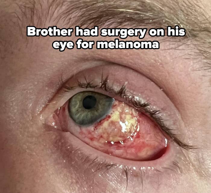 Close-up of an eye with noticeable redness and discharge, indicating an infection or irritation