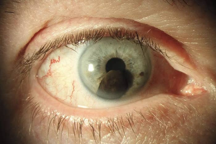 Close-up image of a human eye showing details of the iris, eyelashes, and small blood vessels. No visible clothing or background