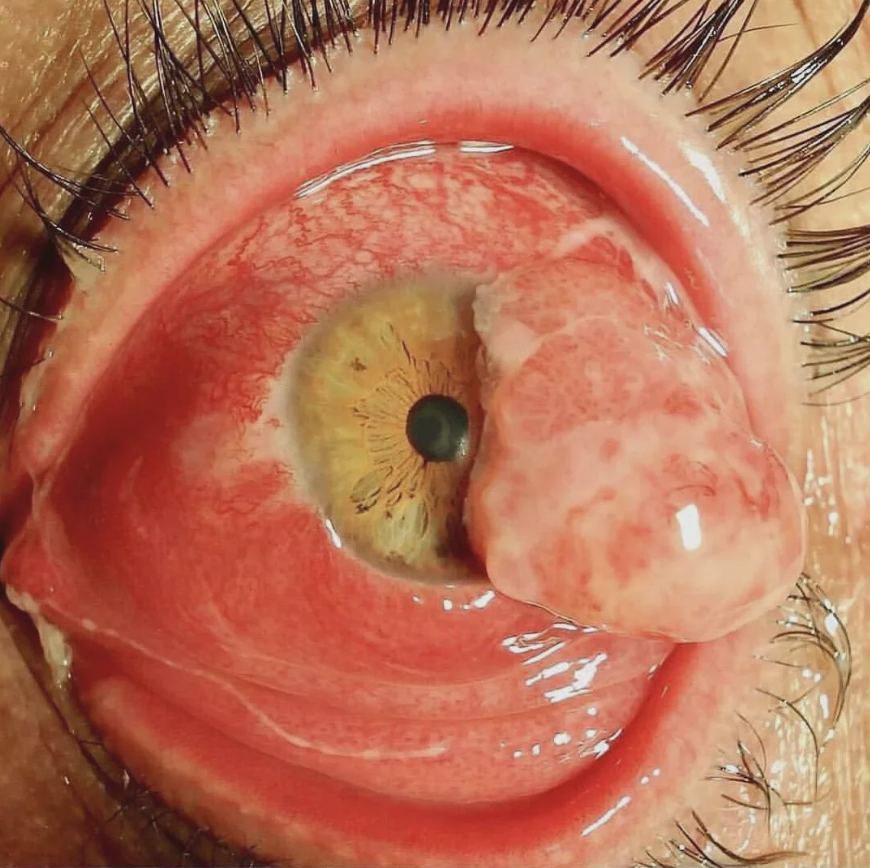 Close-up of an eye with a large, swollen, and irritated area overlapping the iris, resembling a severe eye infection or condition