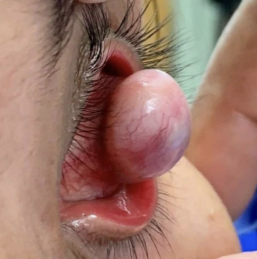 Close-up of an eye with a large, swollen, red and purple growth beneath the eyelid, surrounded by eyelashes