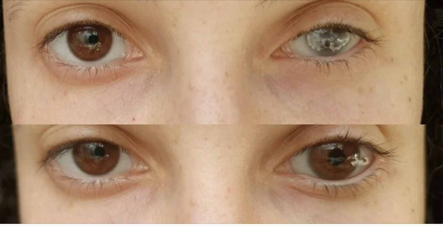 Two close-up images showing eyes, with the top image displaying a cloudy right eye and the bottom image showing both eyes clear
