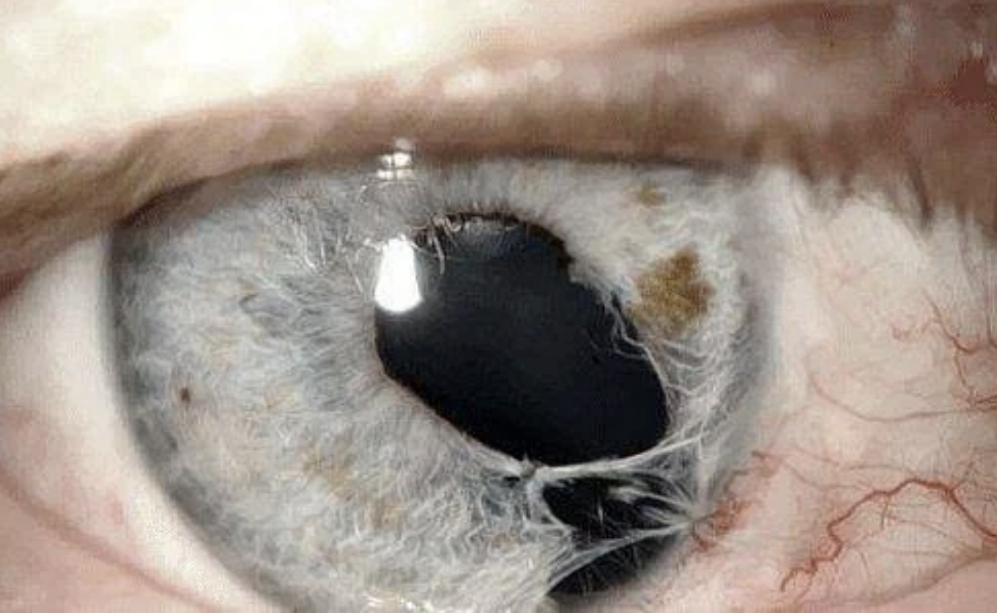 A close-up image of a human eye with a unique and irregularly shaped pupil, showing detailed textures and patterns of the iris