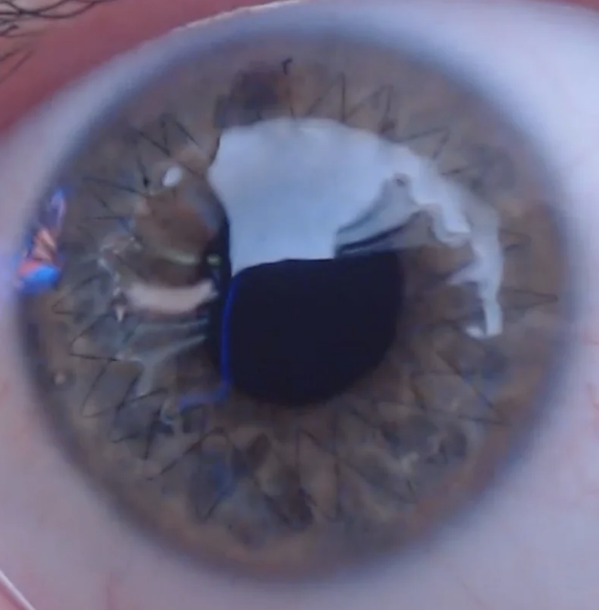 Close-up image of a human eye with intricate stitching around the iris, indicating possible ophthalmic surgery