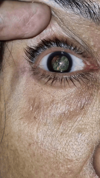 Close-up image of a person's eye being held open, with a reflection of a natural scenery in the pupil