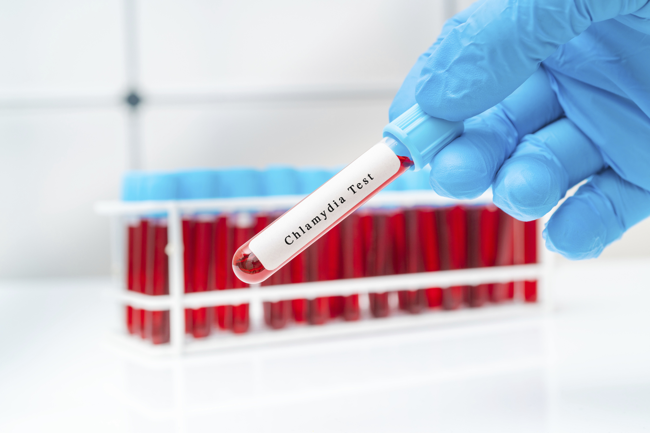 A gloved hand holding a test tube labeled "Chlamydia Test" in a lab, with a rack of red-capped test tubes in the background