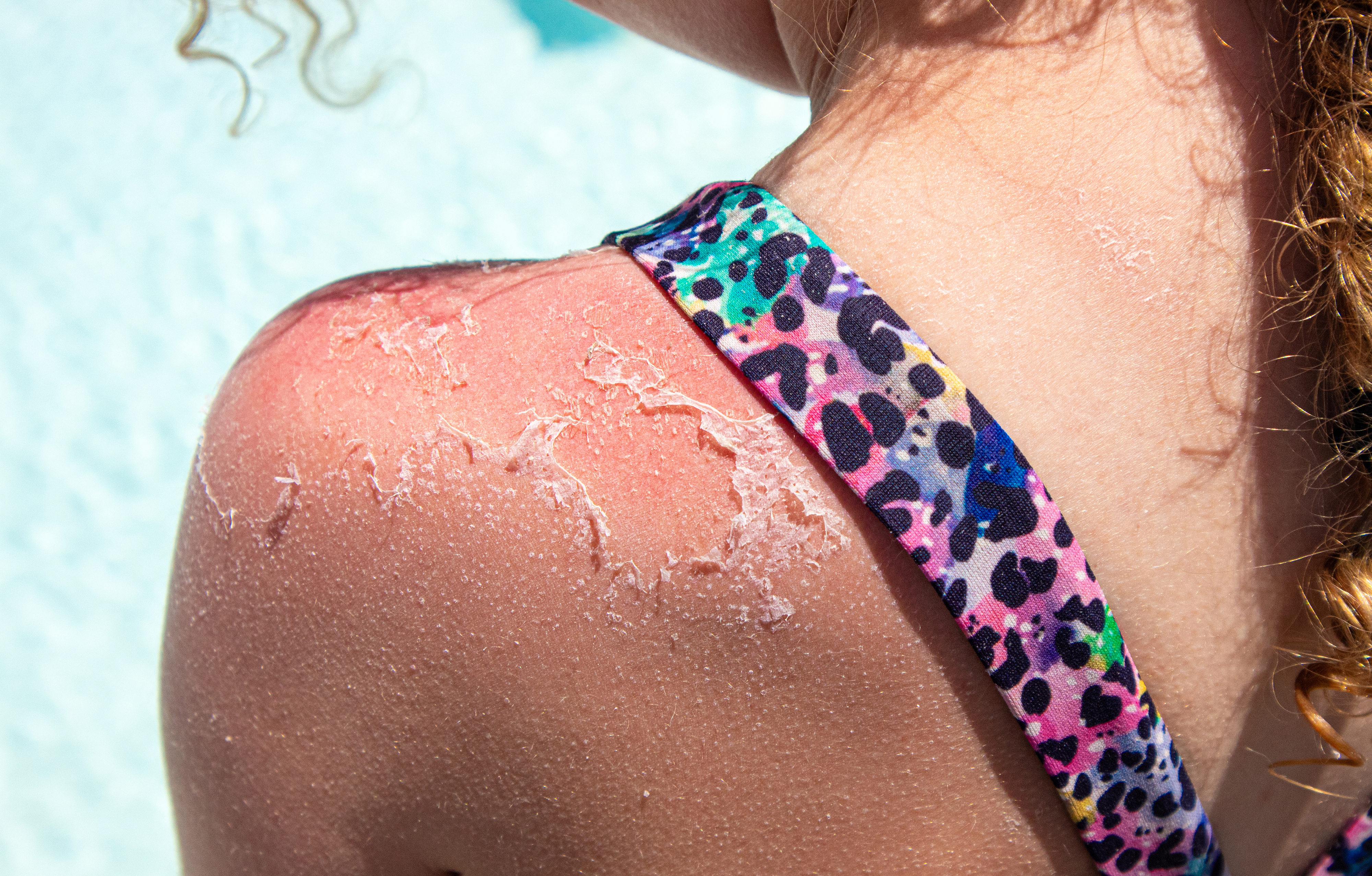 A child's sunburned shoulder with peeling skin is shown close up. The child is wearing a swimsuit with a colorful leopard print strap