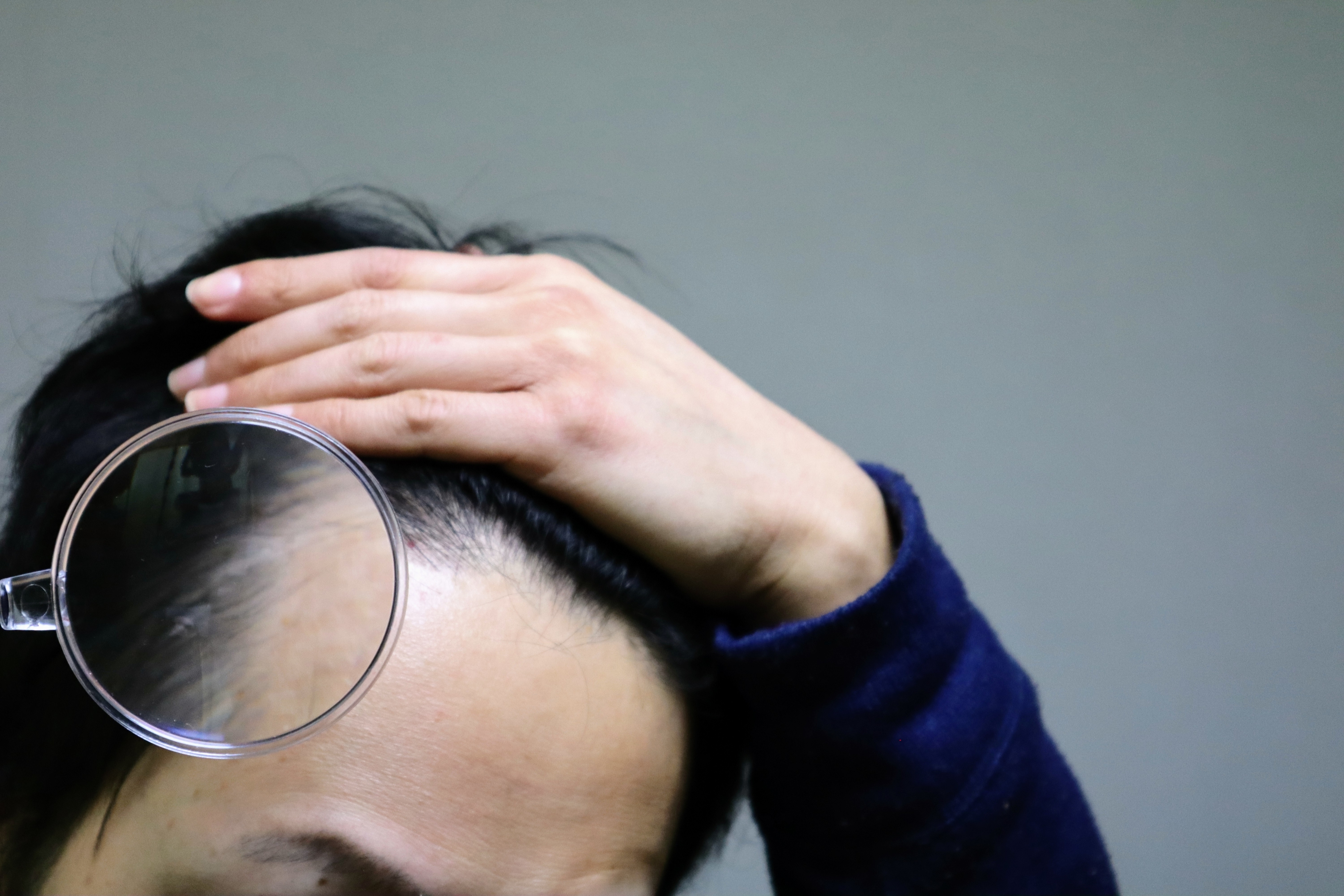 A person holding a magnifying glass to their scalp, examining hair loss with one hand placed on top of their head.