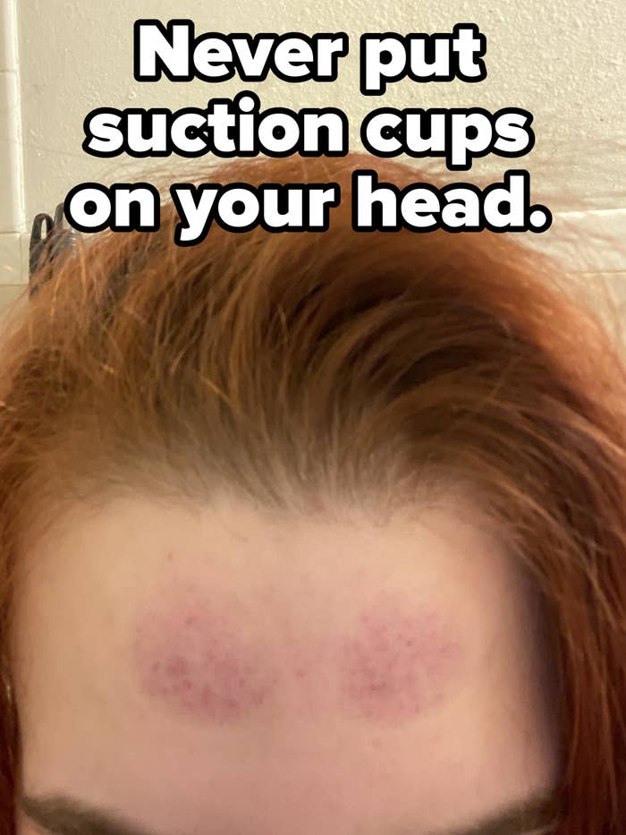 Person with red hair showing two circular bruises or marks on their forehead