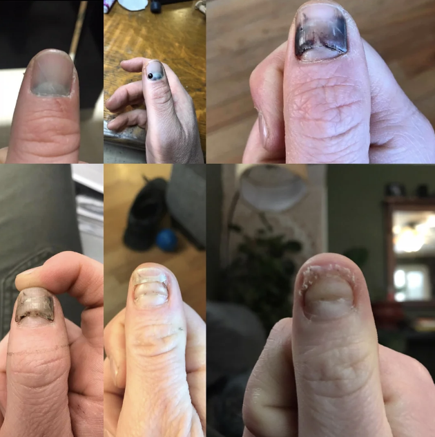 Close-up collage showing six different injured thumbs with various levels of bruising and damage to the nails