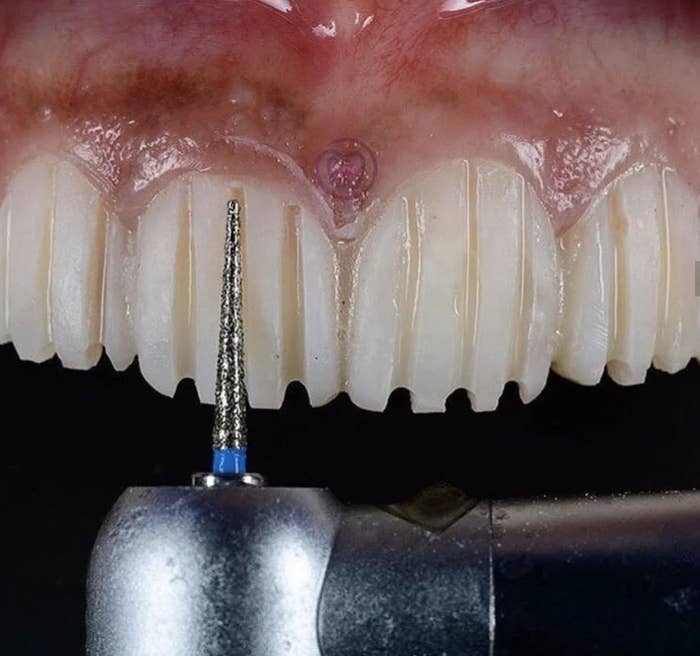 A close-up image shows a dental drill working on teeth, likely during a dental procedure, focusing on the front upper teeth