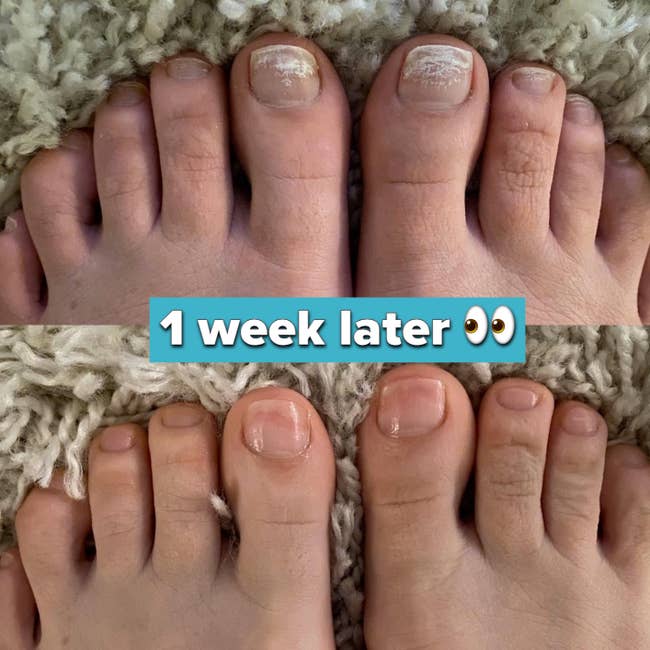 reviewer's feet with toenails showing disposable marks connected them / bottom: 1 week later, marks are gone and nails are clear