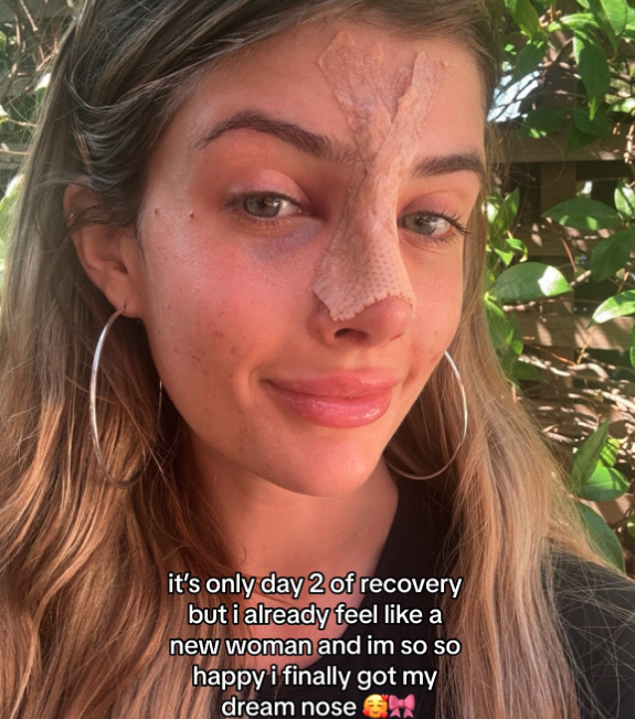 Sami with bandages on her nose, smiling. Text reads: &quot;It’s only day 2 of recovery but I already feel like a new woman and I’m so happy I finally got my dream nose ??.&quot;