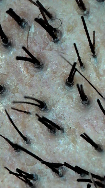 Close-up of human skin showing hair follicles with some short and long hairs