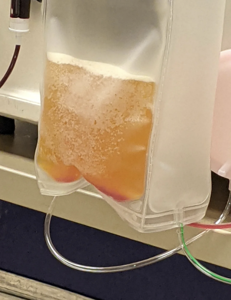 Close-up of a medical IV fluid bag containing a yellowish liquid, with red particles settled at the bottom, connected to tubing