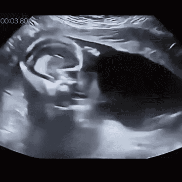 A moving ultrasound scan of a fetus in a womb