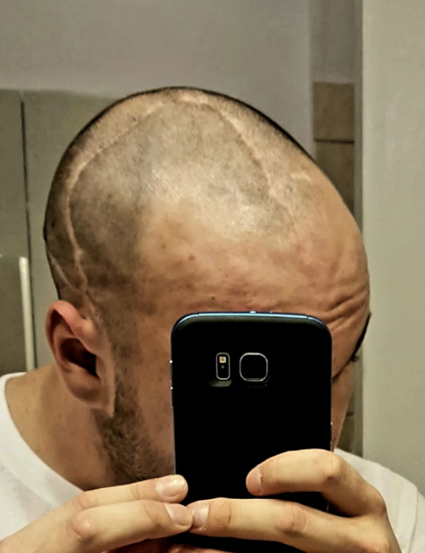 A person with a buzzed haircut takes a mirror selfie, revealing surgical scars on their head. Their face is partially obscured by the phone they are holding