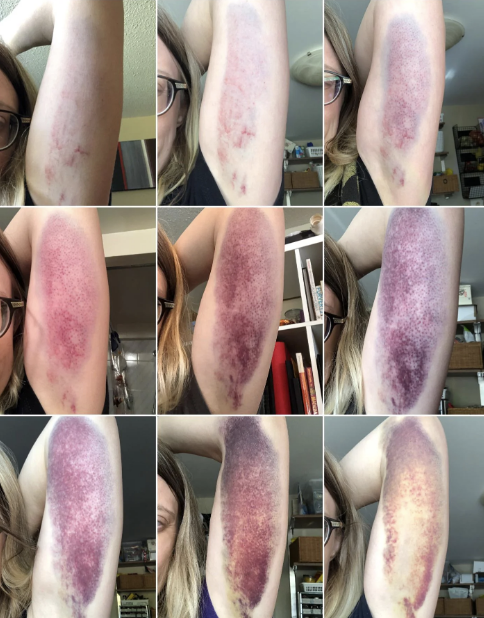 A person documents the progression of a bruise on their upper arm in a grid of nine photos taken over time