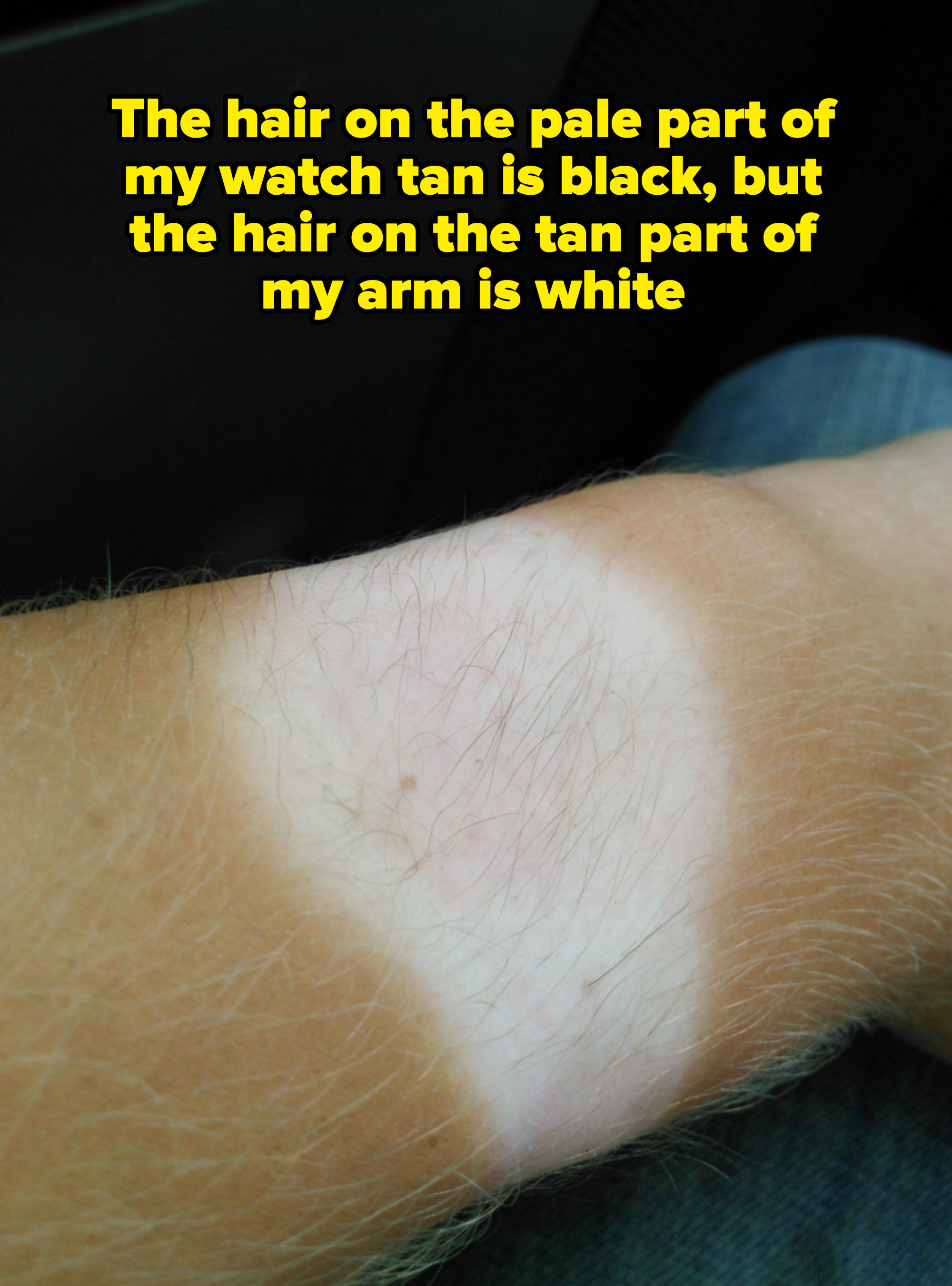 Close-up of a person's forearm showing a prominent tan line from wearing a watch. The skin under the tan line is significantly lighter