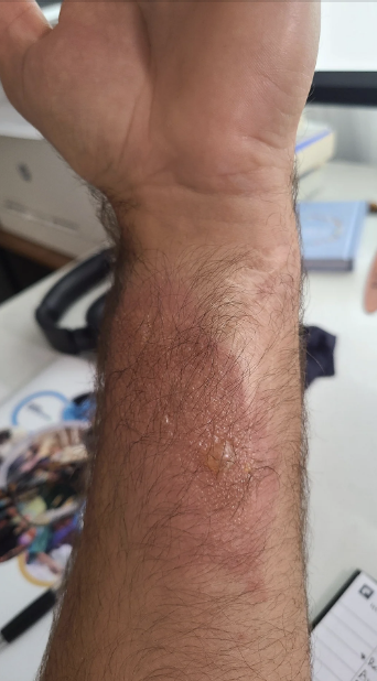 Close-up of a person’s forearm with a healing skin condition, showing redness and dry patches. Background includes indistinct office items and a photo
