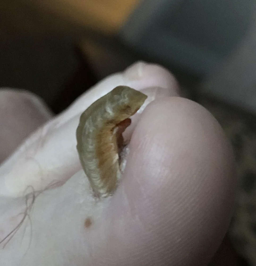 Close-up of a human toe with an ingrown toenail causing significant swelling and discomfort. No other objects or people are present in the image