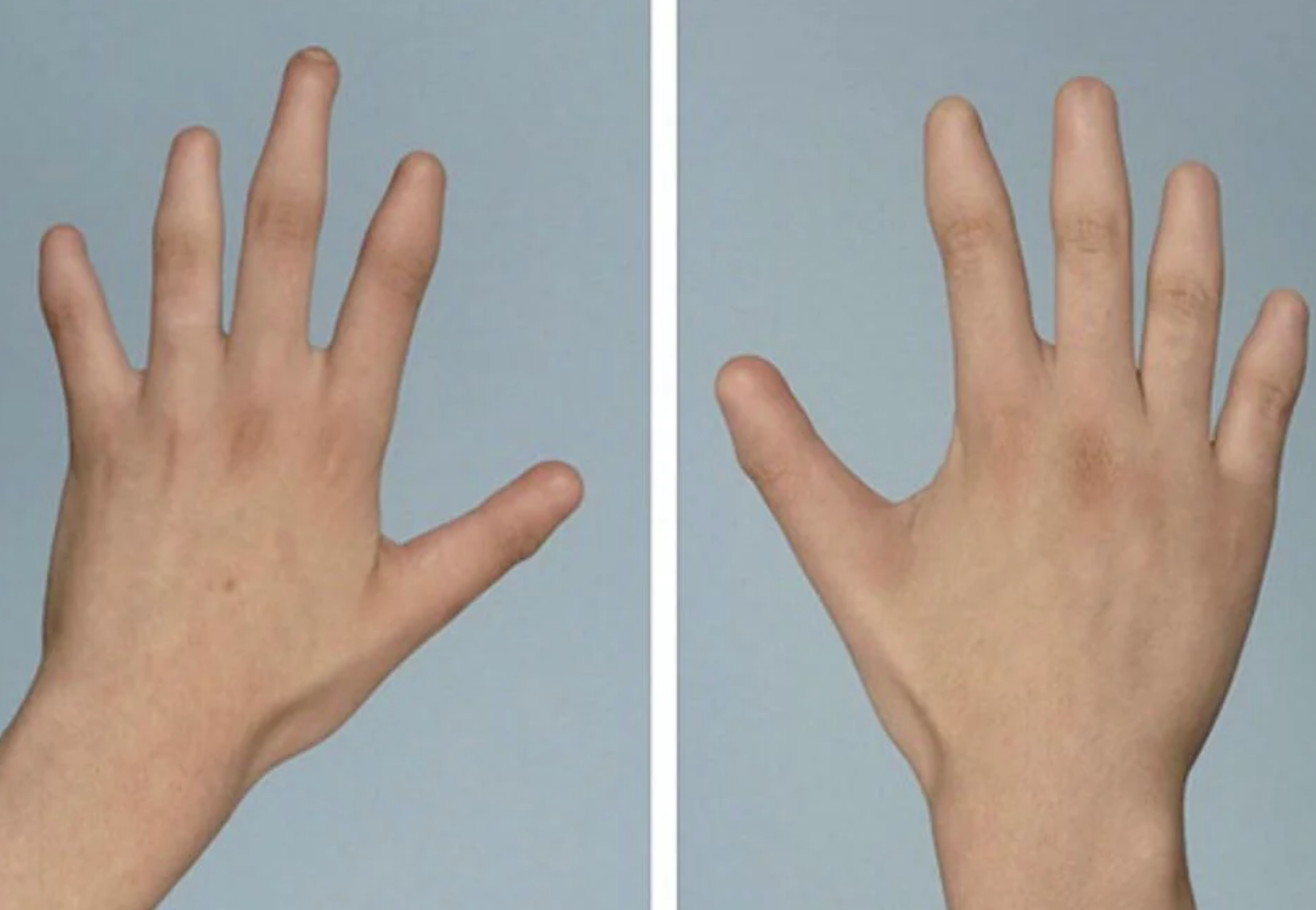 Two left hands with five fully formed fingers on the left and two fused fingers on the right against a plain background