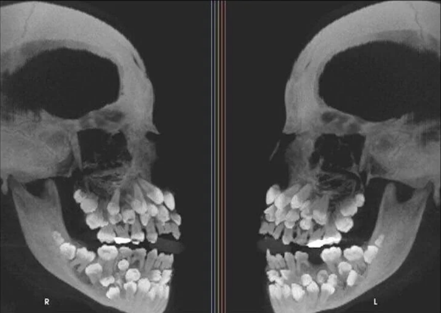 X-ray image of a person's skull showing multiple impacted teeth in both right and left side views