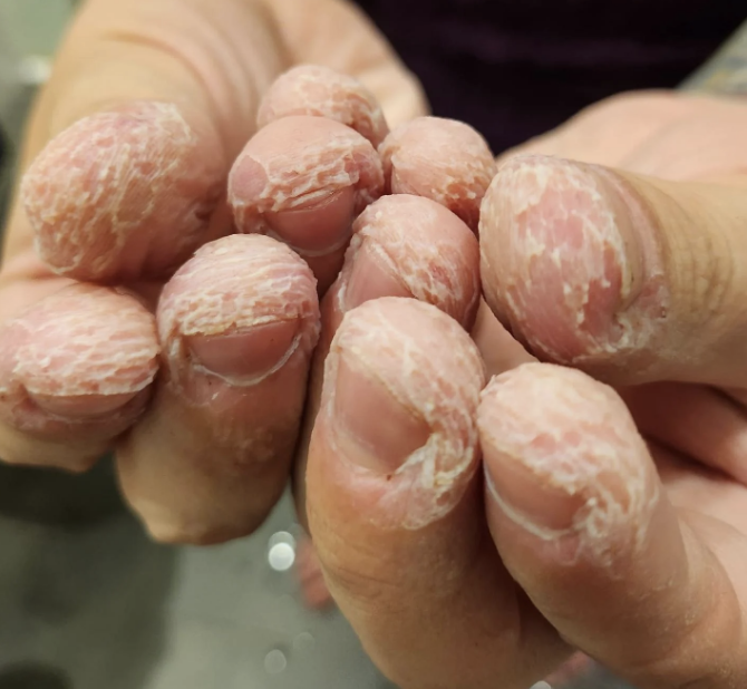 A close-up of hands with severely dry, peeling skin on the fingers