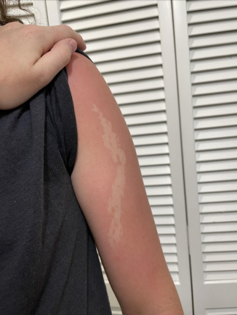 A person with a sunburn on their upper arm shows a distinct patch of unburned skin in a curvy shape