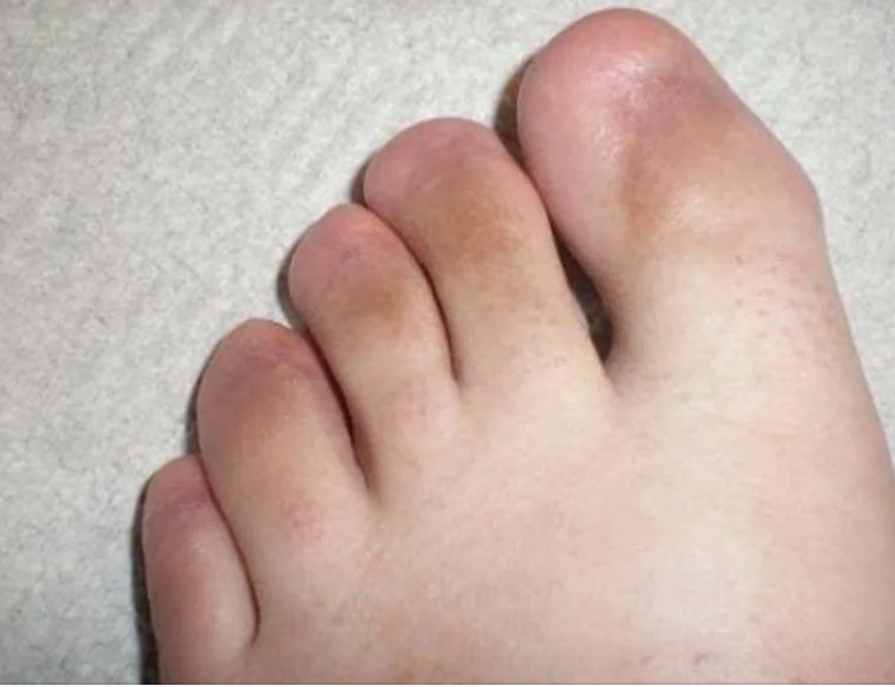 Close-up of a swollen foot with discolored toes