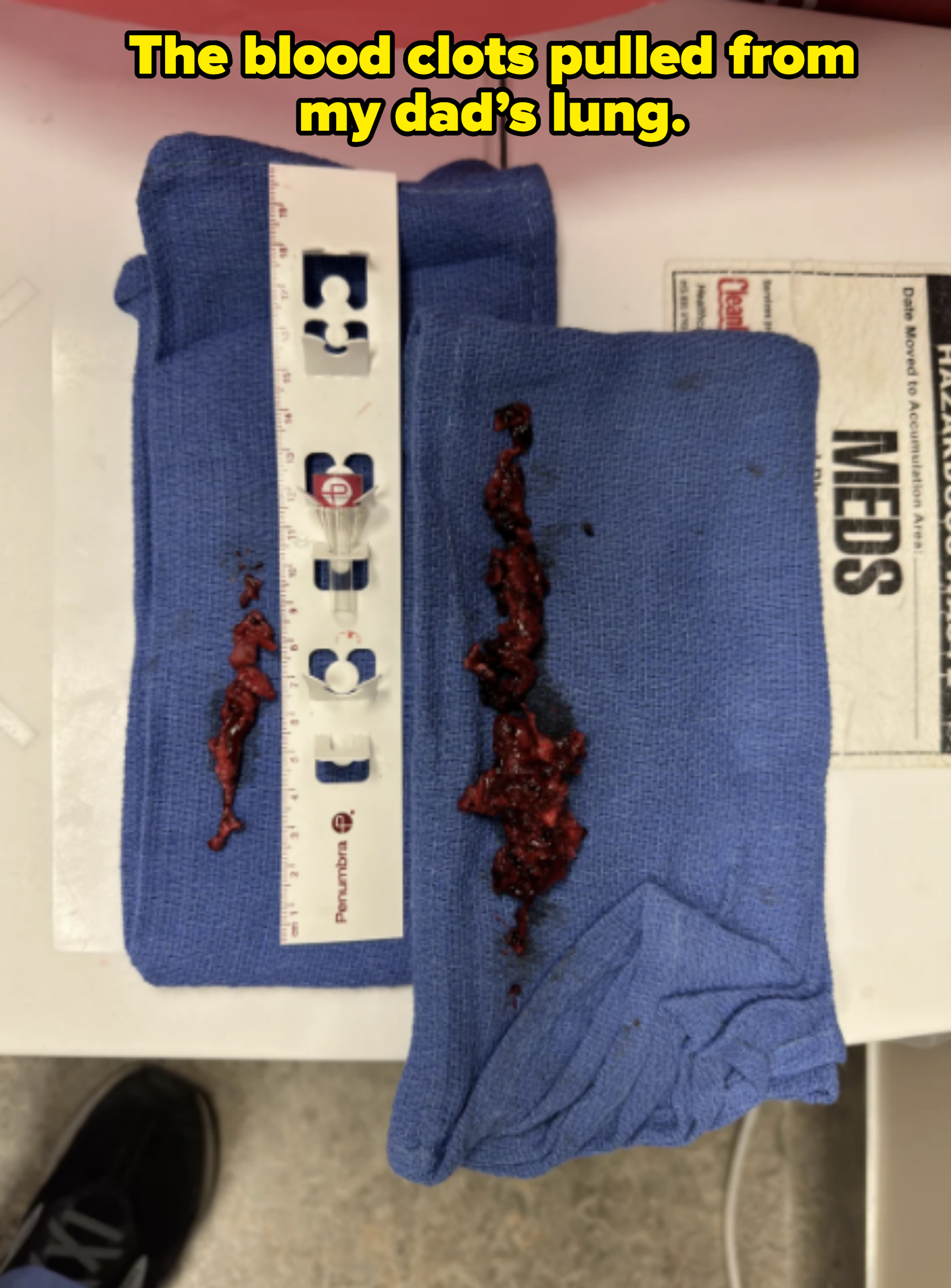 Two pieces of tissue on blue cloth alongside a ruler for scale on a medical table. Text on the right side reads "MEDS."
