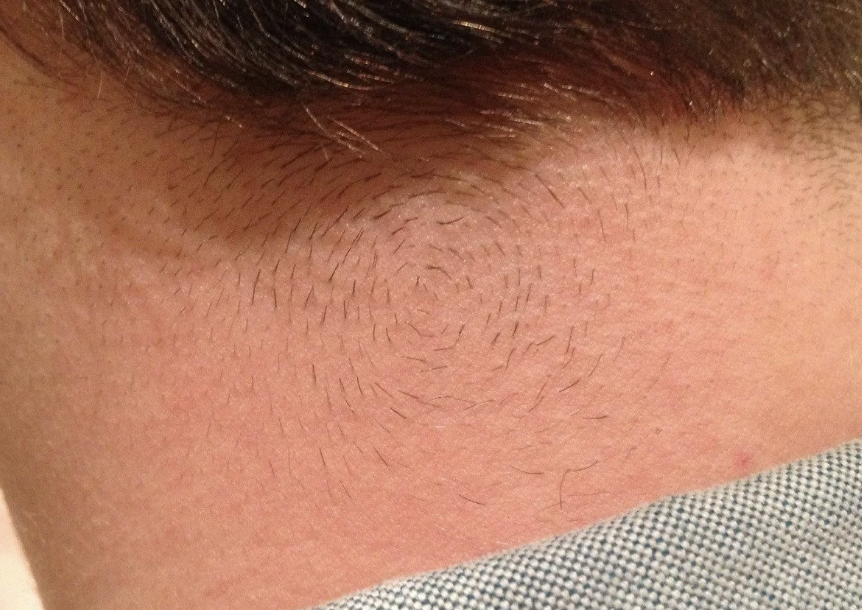 Close-up view of the back of a person's neck revealing a pattern of hair growth swirling in a circular direction