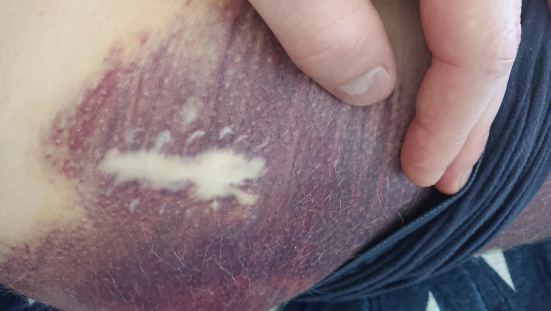 Close-up of an unidentified person's skin showing a bruised area with a small, white, scar-like mark. A hand is lightly touching the bruised skin