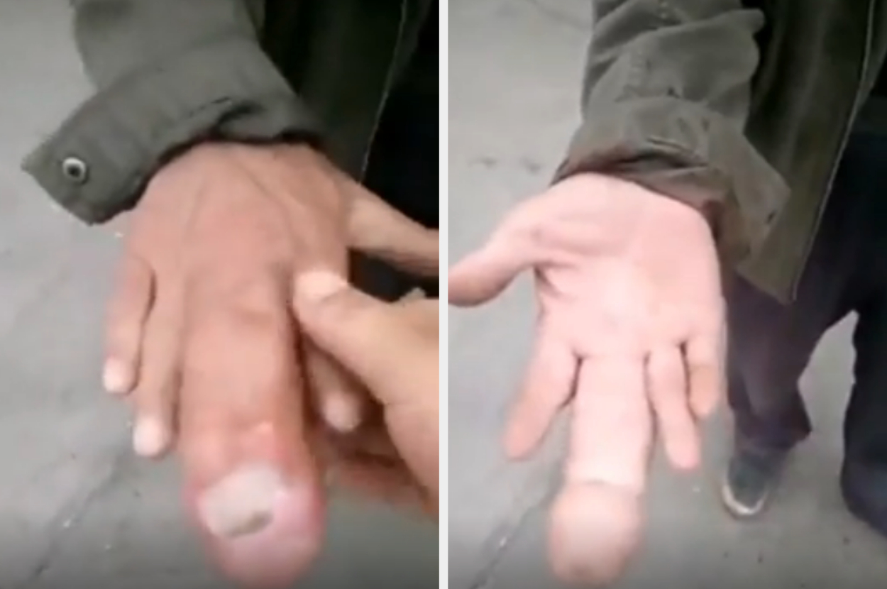 A close-up of someone's injured finger shown in two frames, one with a hand pointing at the injury and another with the injured finger extended. No people identified