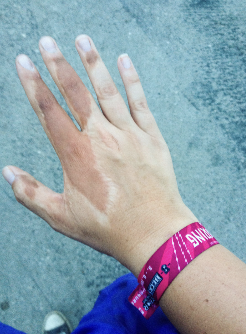 A hand with vitiligo wears a pink festival wristband with text. The skin condition shows patches of lighter skin. The background is a grey surface