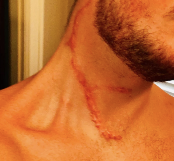 A man with a beard shows a prominent scar running down his neck to his chest
