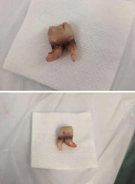 Two extracted teeth with visible roots, placed on white gauze pads
