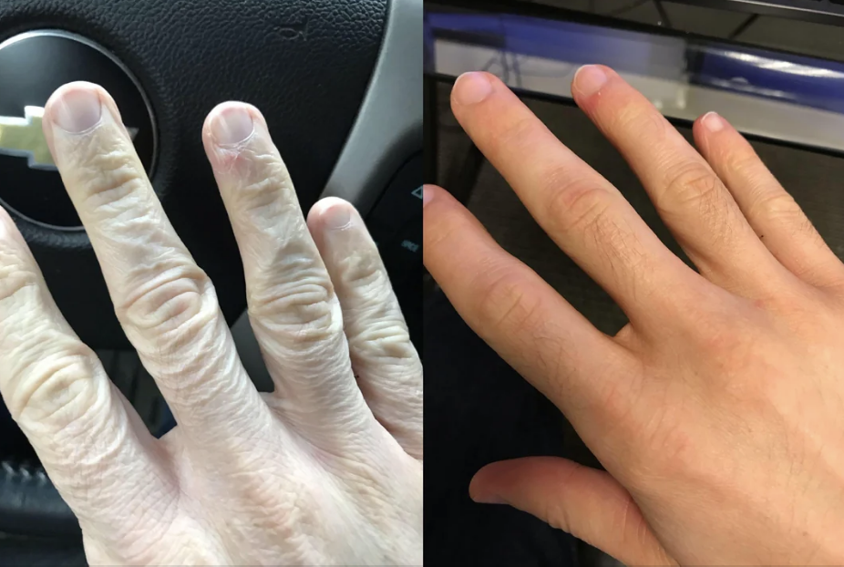 Side-by-side comparison of two human hands, one looking wrinkled and dry on a steering wheel and the other looking smooth and healthy on a desk