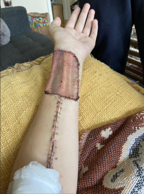 A person's arm resting on a surface shows a large rectangular skin graft and stitches extending down the forearm