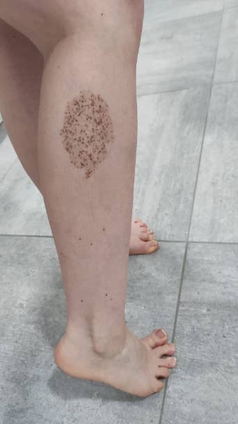 A close-up view of a person's leg, featuring a densely clustered mole pattern on the calf, with feet visible on a tiled floor
