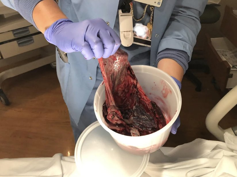 Person in medical clothing and gloves holds a placenta over a plastic container in a clinical setting