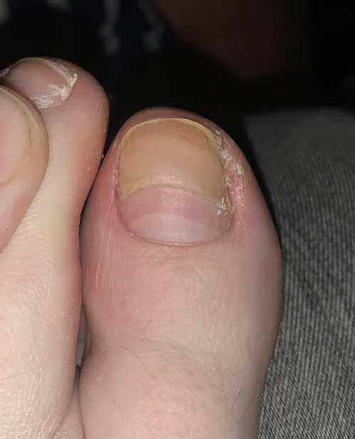 Close-up of a large toenail with a visible white nail bed