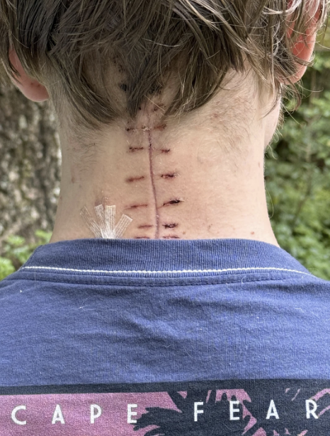 A person with short hair shows a vertical surgical scar with stitches on the back of their neck, wearing a blue T-shirt