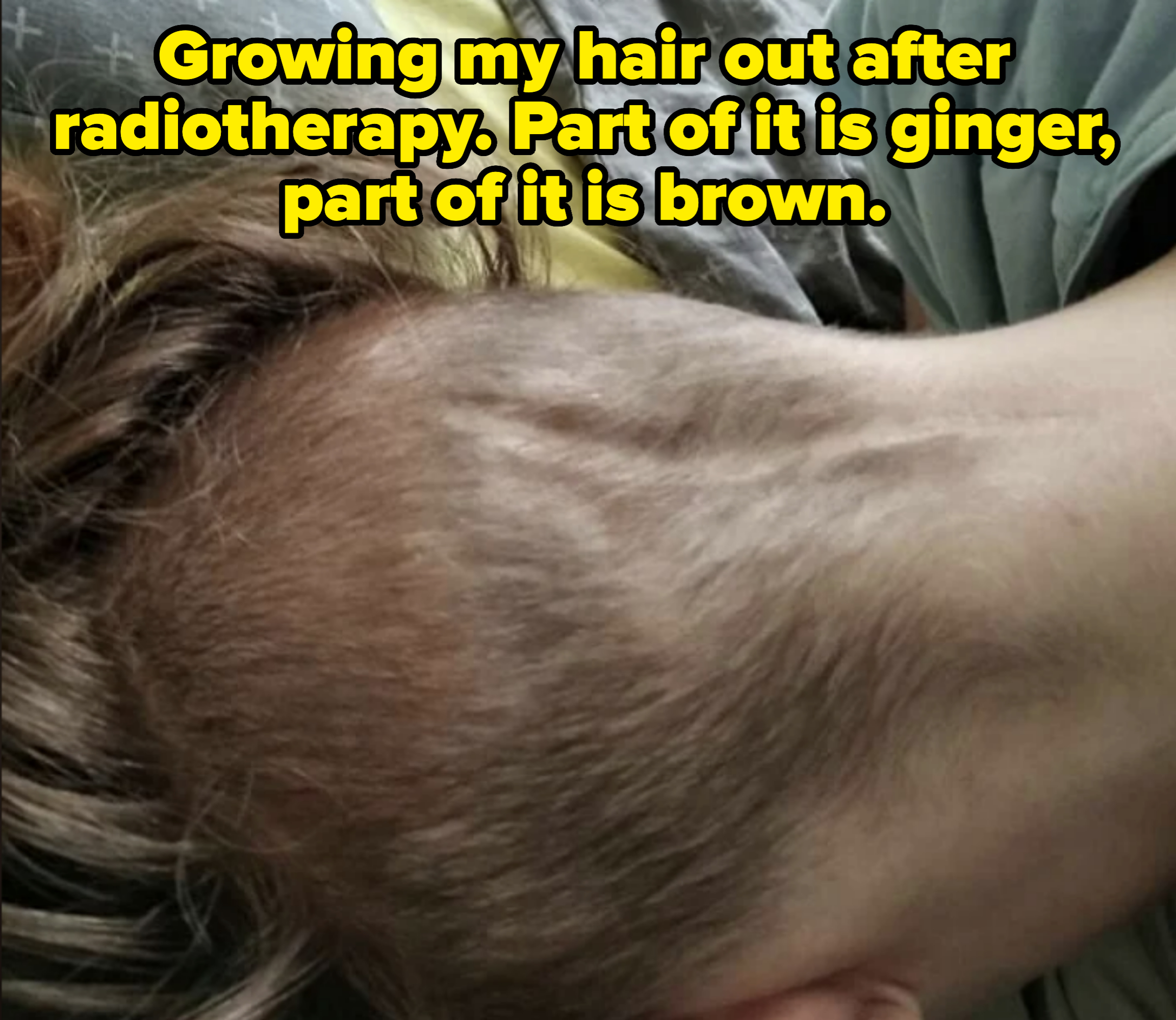Close-up view of a person with partial hair loss on the back of their head, showing some regrowth. No other pertinent details or people