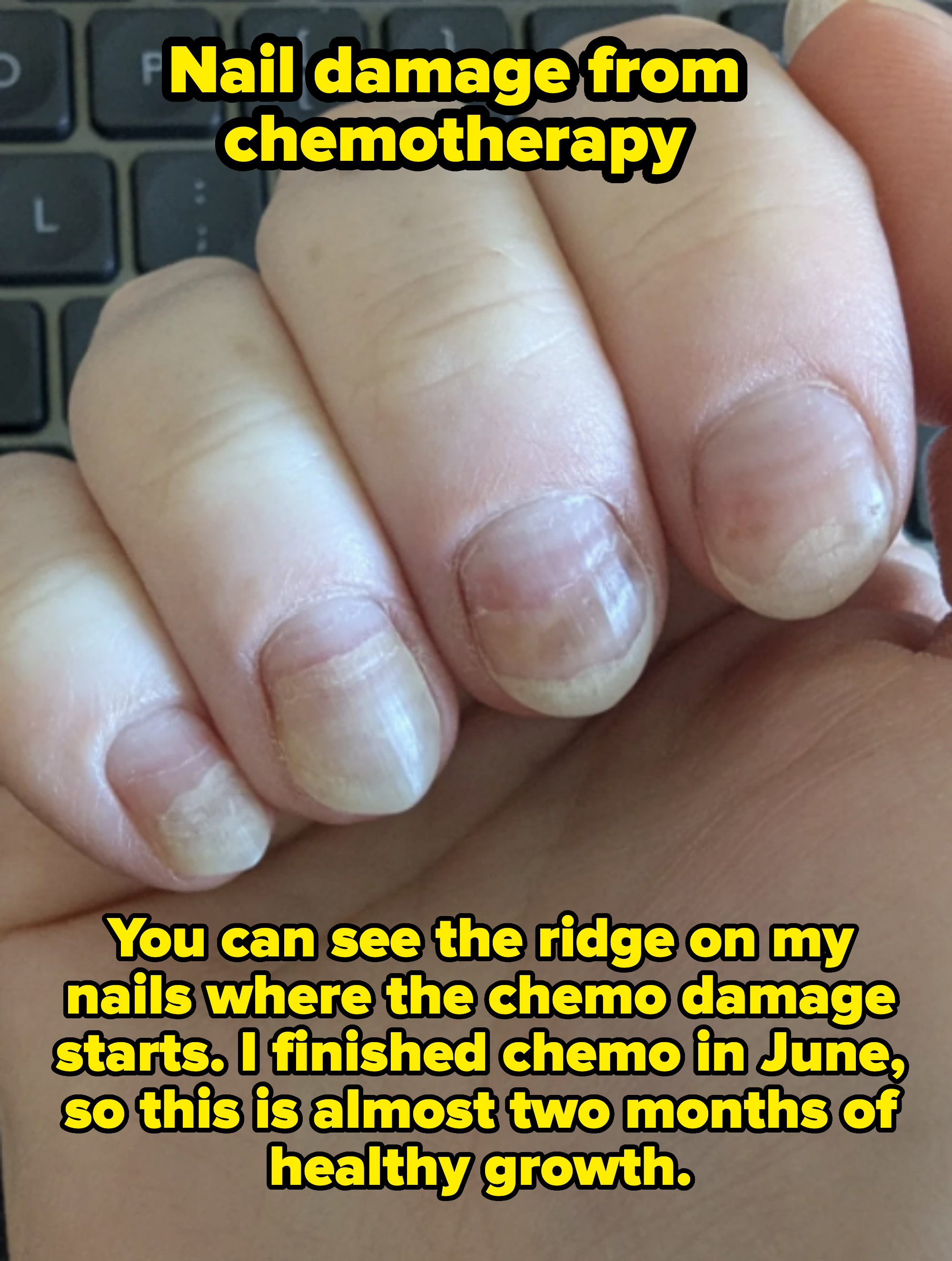 A close-up of a hand with damaged nails in front of a keyboard. The nails appear cracked and brittle