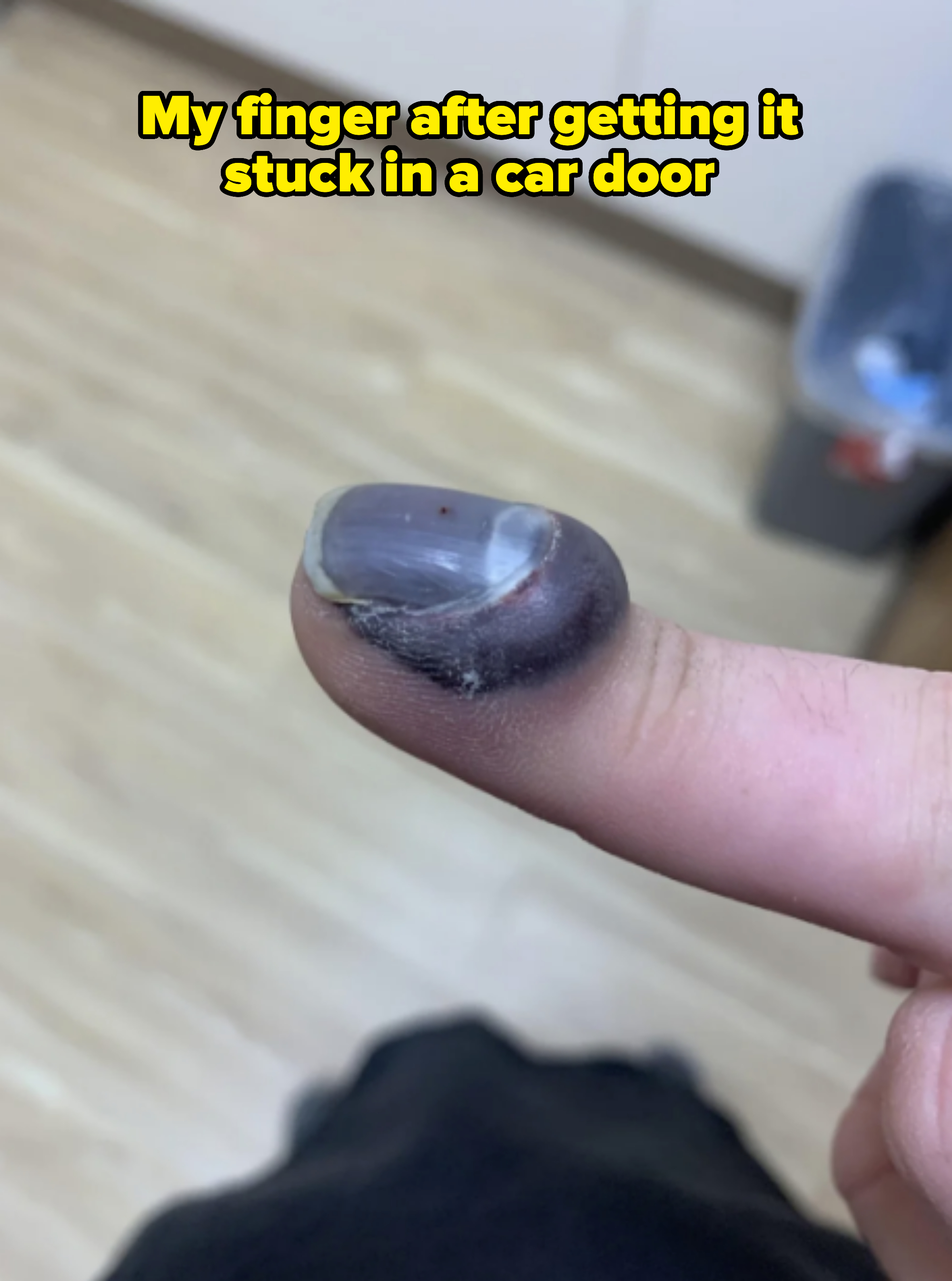 Bruised and swollen finger with a heavily damaged and discolored fingernail, possibly injured. Background shows a lightly blurred indoor setting