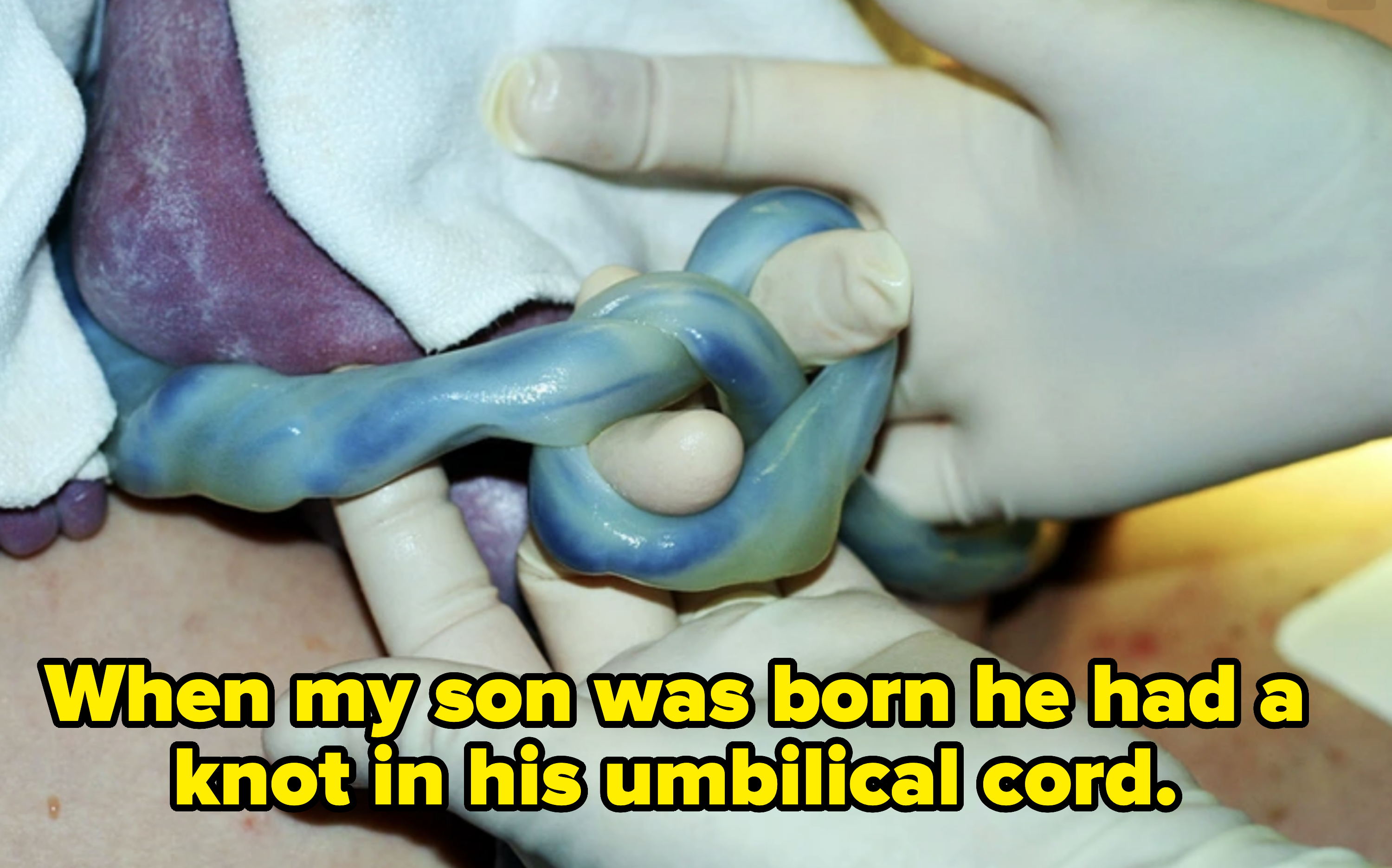 Hands in gloves holding a knotted umbilical cord during birth. The baby is partially visible, covered with a cloth