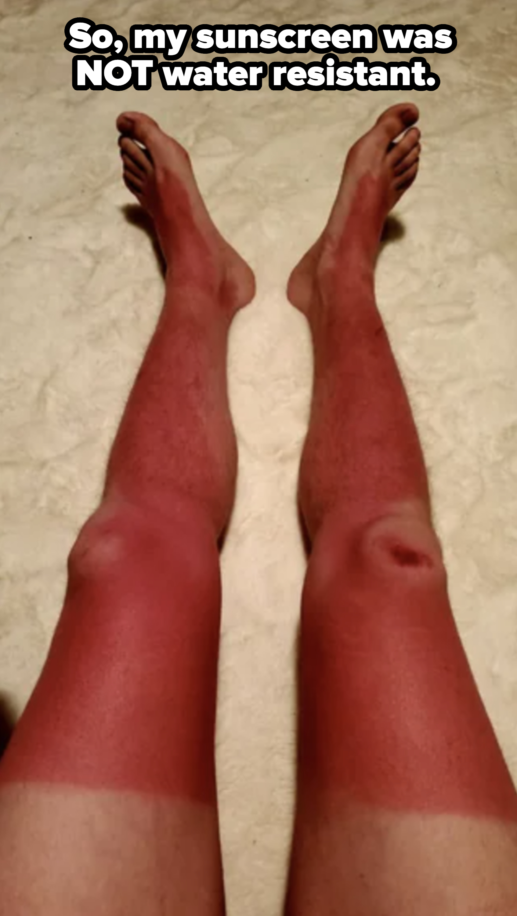 Person's legs with a sunburn, showing a clear line of contrast where the skin was protected by shorts