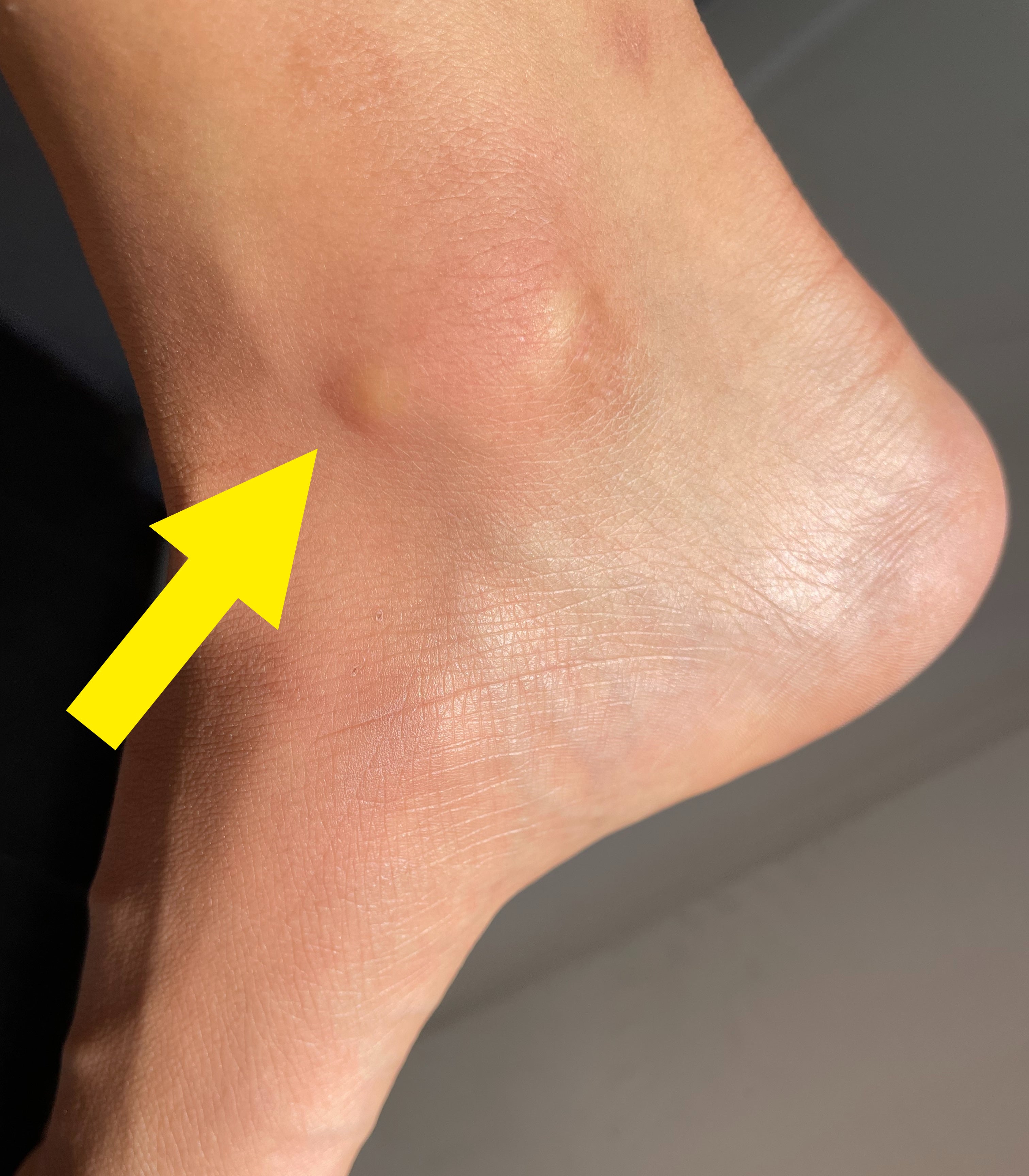 Close-up view of a human foot showing a mild swelling on the ankle
