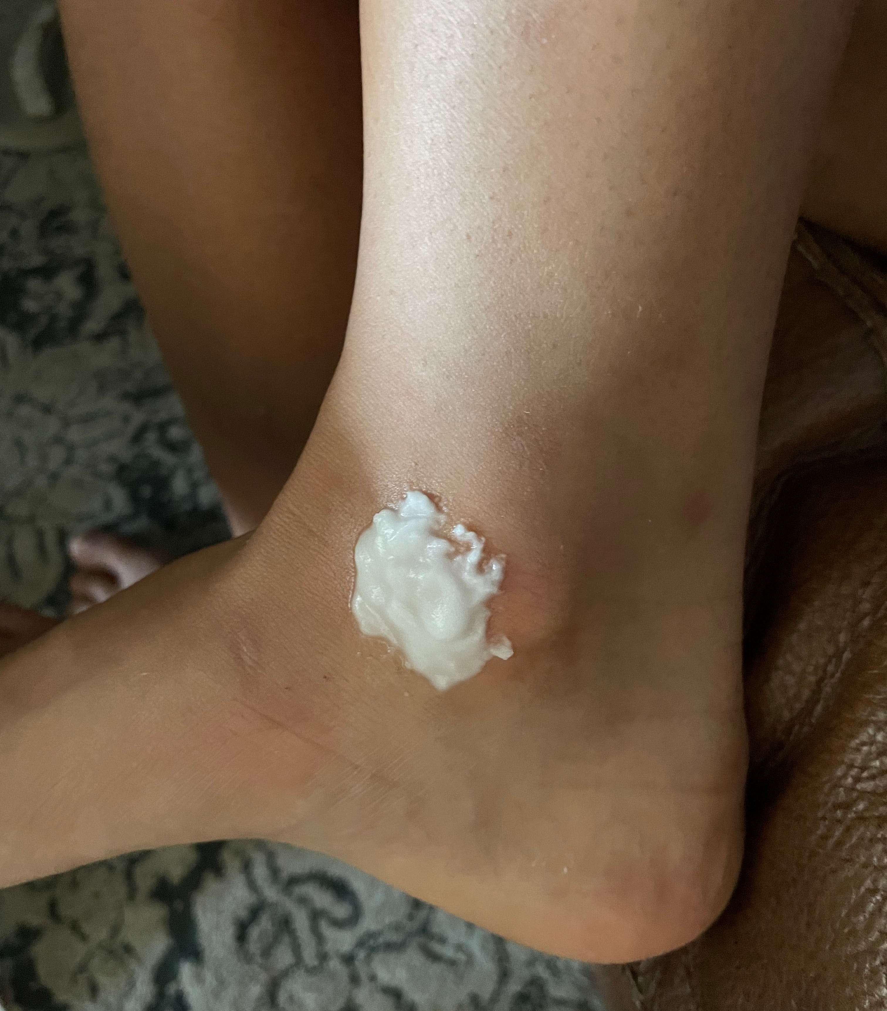 Close-up of a person’s ankle with a dab of baking soda paste applied to a small area