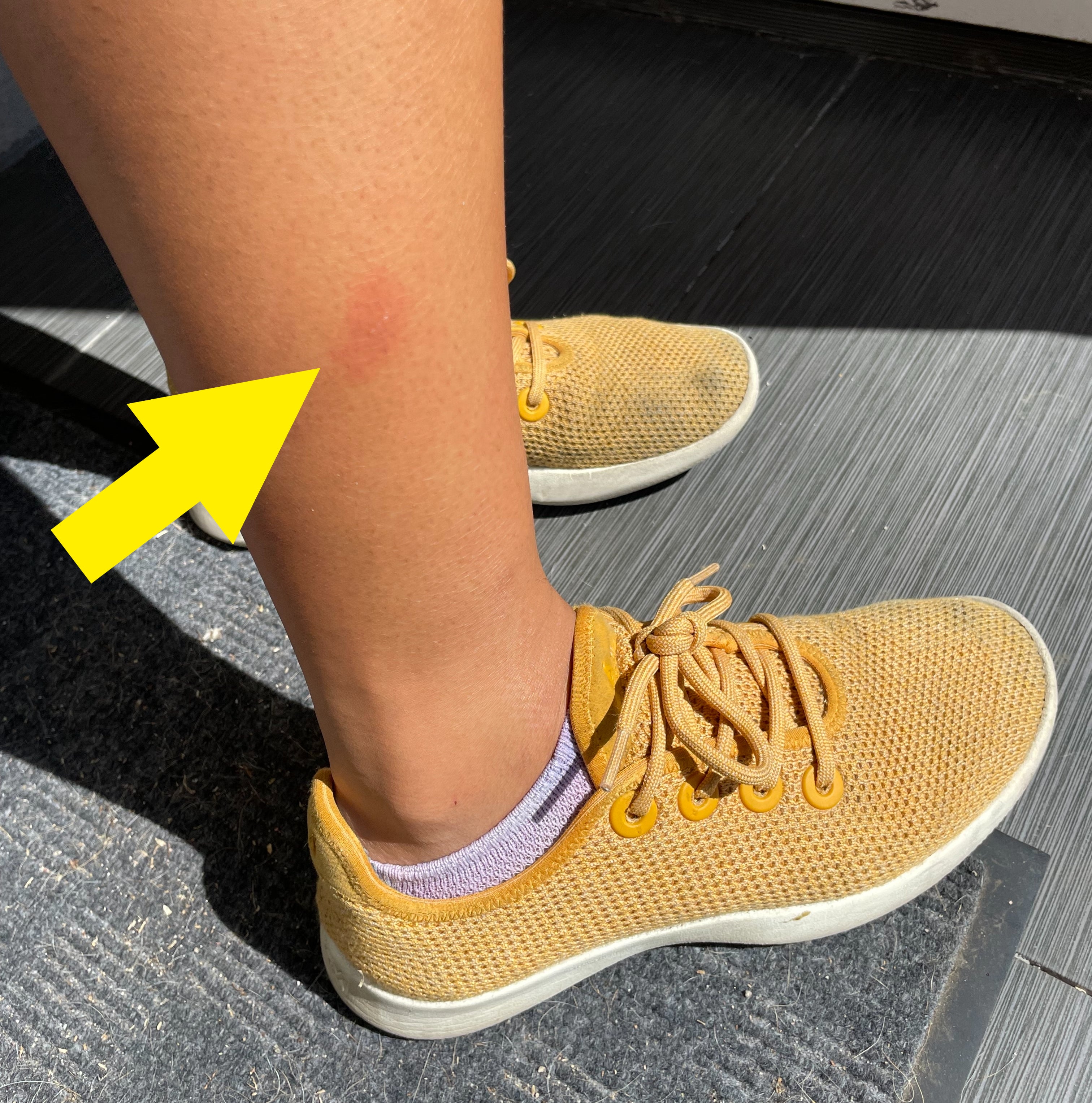 Close-up of someone's lower leg and feet, with an arrow pointing to a mosquito bite on the leg